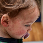 Child dies of horrifying measles complication in Los Angeles