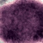 In 2022, the world axed a disease name seen as racist. US just switched back.