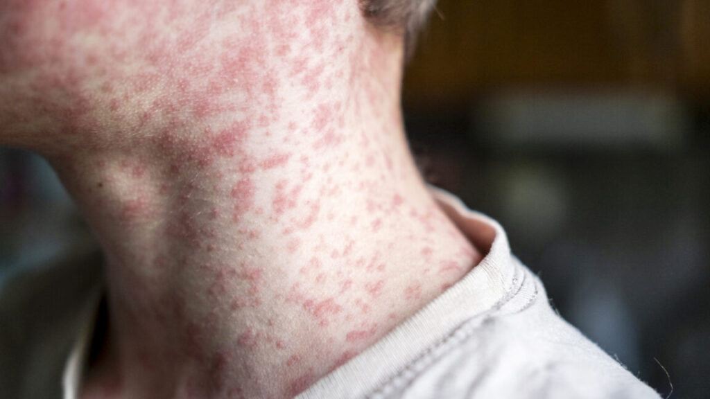 Measles outbreak investigation in Utah blocked by patient who refuses to talk