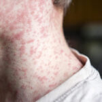 Measles outbreak in SC sends 150 unvaccinated kids into 21-day quarantine