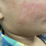 Measles continues raging in South Carolina; 99 new cases since Tuesday