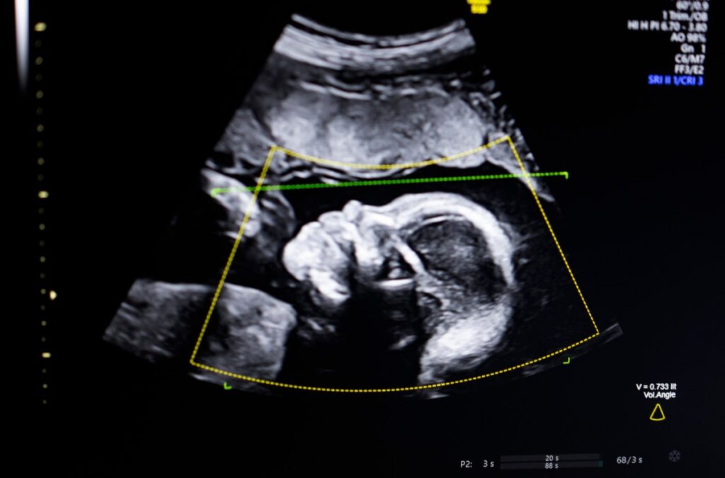 Biotics AI, Battlefield 2023, gains FDA approval for its AI-powered fetal ultrasound product 