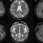 You’re likely already infected with a brain-eating virus you’ve never heard of