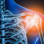 Doctors took a look at man’s painful shoulder—they found the joint was missing